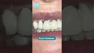 Essix Retainer:Temporary Solution for Missing Front Tooth #invisiblealigners #dentalawareness #viral