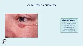 Comment d&eacute;crire une l&eacute;sion dermatologique de mani&egrave;re standardis&eacute;e