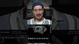 Ultraschall in der Schwangerschaft - das sieht ein Frauenarzt