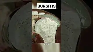 Bursitis #bursitis #bursa #inflammation #physicaltherapy#shoulder #pain #shorts #movement #anatomy