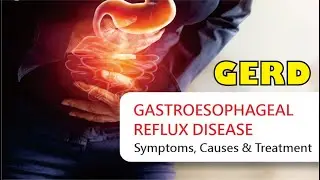 GERD (GASTRO ESOFAGEAL REFLUKS DISEASE) KENALI GEJALANYA, PENYEBAB DAN PENATALAKSANAANYA