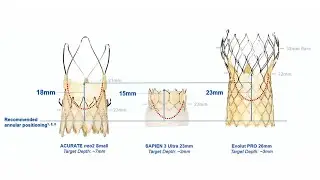 TAVI: from first valve to lifetime management - Webinar