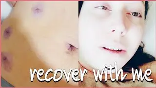 HERNIA+DIASTASIS RECTI SURGERY VLOG/ RECOVERY VLOG/ Michaela Scull