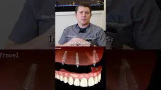 All-on-X Implants: Explained
