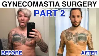 Gynecomastia Surgery Q & A - Part 2 | My Gynecomastia Surgery Recovery