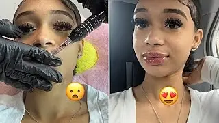TRYING NEEDLESS LIP FILLER FOR THE FIRST TIME VLOG