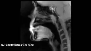 Brass Player MRI