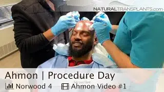 Hair Transplant Procedure For Men: An Inside Look | Dr. Blumenthal (Ahmon)