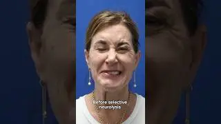 HUGE transformation after selective neurolysis surgery #plasticsurgery #facialparalysis #facialpalsy