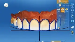 Porcelain Crowns | Smiles Peru | Coronas de Porcelana