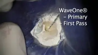 WaveOne&reg; - Dr. Bill Nudera WaveOne&reg; Case study | DENTSPLY