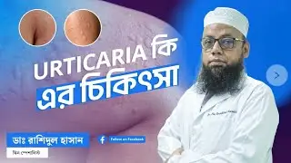 Urticaria/আমবাত, একটি অতি পরিচিত এলারজি জনিত রোগ