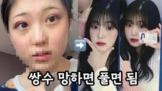 망한 쌍수 풀고 무쌍으로 돌아가기 / 매몰 풀기 후기/ 쌍수 푸는 브이로그