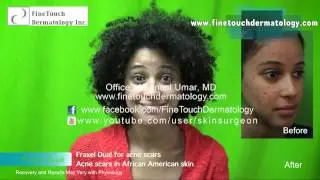 Laser Skin Resurfacing on African-American Skin: Beverly Hills Fraxel DUAL Patient Results