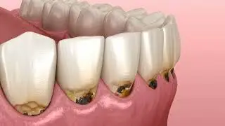 Remove Cavities Naturally at Home Without Drilling | Oil Pulling & Proven Home Remedies