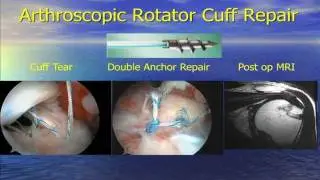 Sports Medicine Update 2010: Rotator Cuff Injuries Presented by Dr. Stephan Yacoubian
