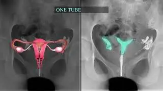 Fallopian Tube Recanalization and Selective Salpingography