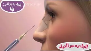 تجميل الأنف بالفيلر