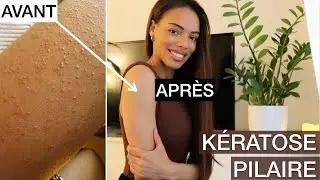 S.O.S: Bras Boutonneux: Kératose Pilaire | Comment s'en débarrasser ?