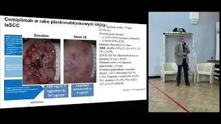 Rak kolczystokomórkowy skóry nowotwór o którym zapominamy