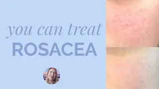 HOW TO TREAT ROSACEA ON THE FACE? Skincare for rosacea & acne rosacea! YES rosacea can be treated!