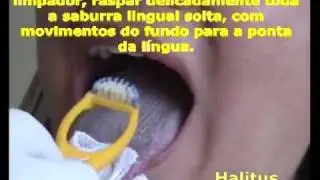 Mau h&aacute;lito, Halitose - T&eacute;cnica DC de limpeza da l&iacute;ngua - Saburra lingual, Caseum