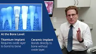 Advantage of Ceramic (Zirconia) Implants