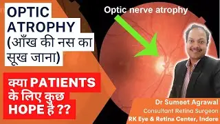 OPTIC ATROPHY : आँख की नस का सूख जाना ! क्या हमेशा के लिए रोशनी हो जाएगी ख़तम ?