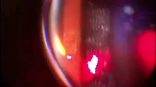 Retinal break repair using lightmed truescan pro 577 laser