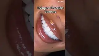 PORCELAIN veneers, SMILE #veneers #viral#oral-health#shorts#dentist#smile