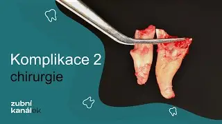 Komplikace v zubařině - chirurgie