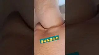 Cannulation.. video.. part 359 #shorts #viral #trending #2023