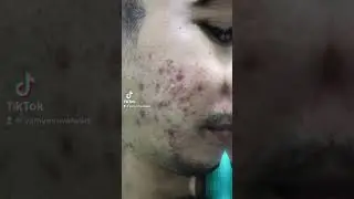 ACNE NO MORE , USING YAMYAM PERFECT SKIN NATURAL AND ORGANIC PRODUCTS OF YAMYAM IN OMAN 🇴🇲