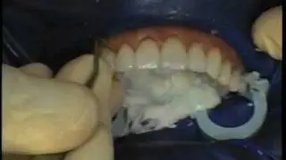 Dennis Wells on Prepless Veneers