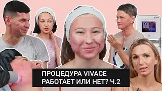 Процедура микроигольчатого rf-лифтинга VIVACE: работает или нет? Реальные отзывы 5 пациентов