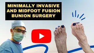 Minimally Invasive and Midfoot Fusion Bunion Surgery: X-Ray Review & Patient Outcome | Dr. Kevin Lam