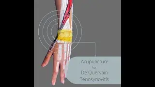 ✨Acupuncture for De Quervain&rsquo;s Tenosynovitis✨ (ENG)