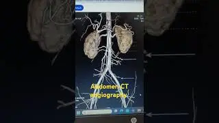 CT ANGIOGRAPHY OF ABDOMEN (SOLID ARROWS-MICROANURYSMS OF MESENTERIC VESSELS,KIDNEY