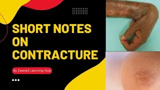 Contractures||Short Notes On Contracture||Contracture Treatment||Zeenad Learning Hub