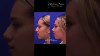 What are the different types of nose definition?