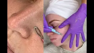 Dull Skin + Stubborn Blackheads & Dermaplaning Facial | Jadeywadey180