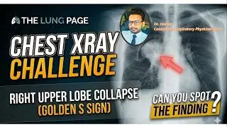 Chest X-ray challenge -12 - Right Upper Lobe Collapse