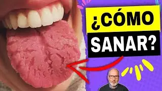 C&Oacute;MO SANAR LA LENGUA AGRIETADA (REMEDIOS NATURALES)