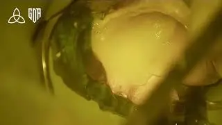 Deep margin management...lowe 8 Distally