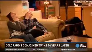 These aren't your typical twins, they were conjoined
