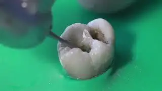 Fast dental filling replacement  #shorts