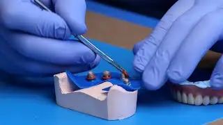 Section A: Preparation | Chapter 5: Placing Separable Fasteners & TiBases onto Multi-Unit Abutment