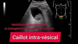 Caillot intra-v&eacute;sical &Eacute;chographie