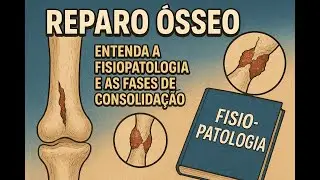 Reparo ósseo: entenda a fisiopatologia e as fases de consolidação