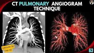 CT Pulmonary Angiogram Techniques (Part-02) | Post Processing | MIP | VRT | Pulmonary Embolism |